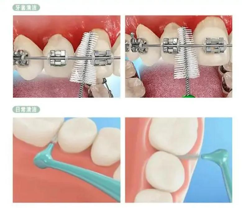 牙齿矫正好以后又长智齿,儿童牙齿矫正佩戴钢丝会更蛀牙吗