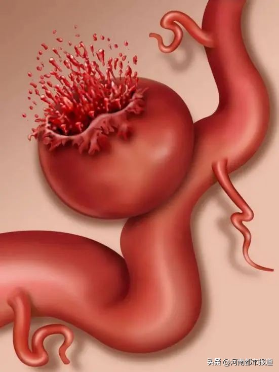 宝宝坠床摔出“动脉瘤”，回老家河南千里寻医