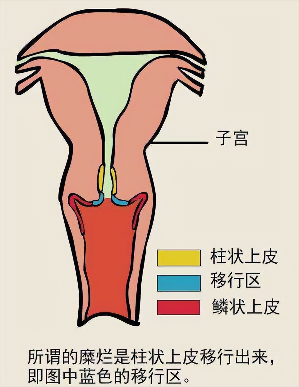 女孩腹痛就医，医生检查发现其阴道处的紫蓝色膨隆，立即引起重视
