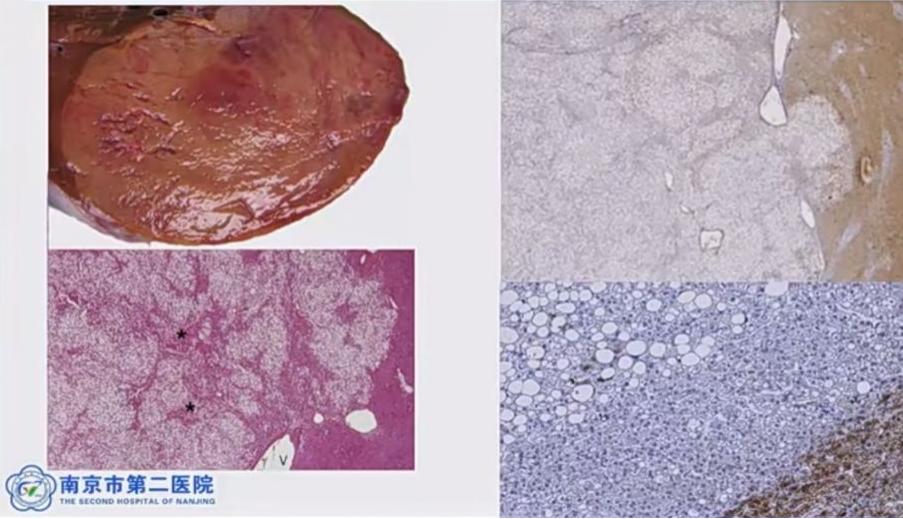 肝囊肿和肝占位影像学鉴别,杨永峰医生个人简历