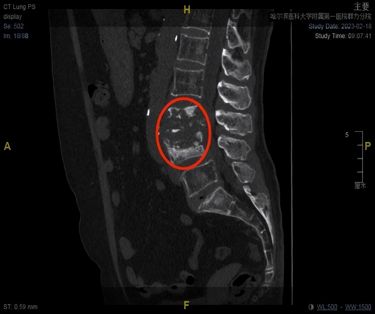 哈尔滨市群力医大一院赵伟,哈尔滨医大一院群力医院赵伟