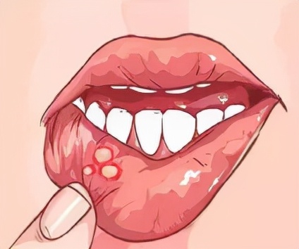 儿童口腔溃疡怎么好得快,口腔溃疡的最快解决办法小孩