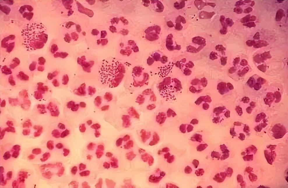 6种通过“性传播”的疾病，你知道几种？私生活别太大意