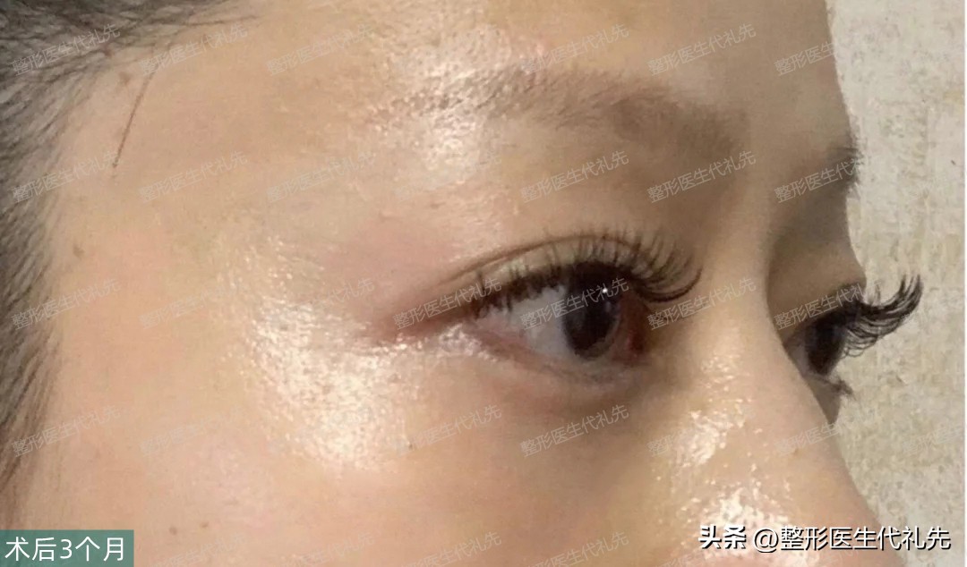 眼袋手术52天,眼袋手术27天了还用抹祛疤膏吗