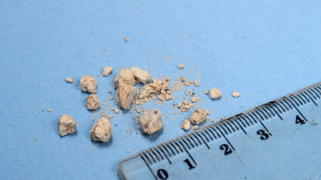 体检查出了肾结石怎么办,体检查出肾结石要不要治疗