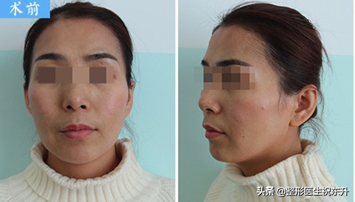 额头不饱满用什么填充最好,颞骨凹陷适合填充什么
