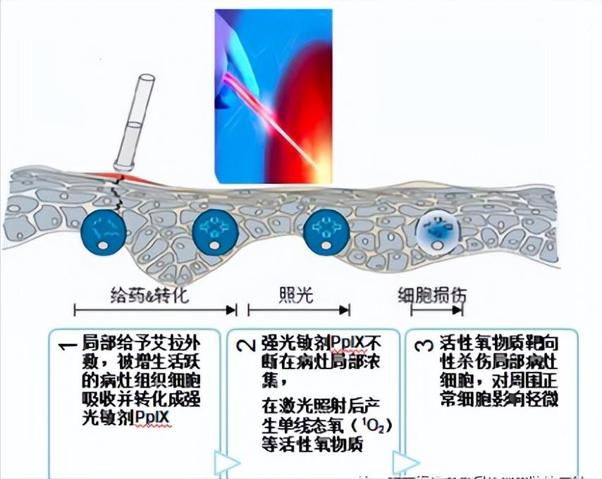 尖锐性湿疣效果最好的治疗方案,尖锐性湿疣治疗最省钱的方法