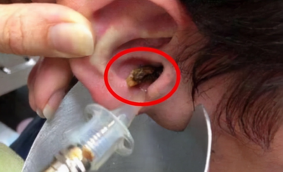 为什么有的是干耳屎有的是湿的,为什么耳屎是湿的或者干的