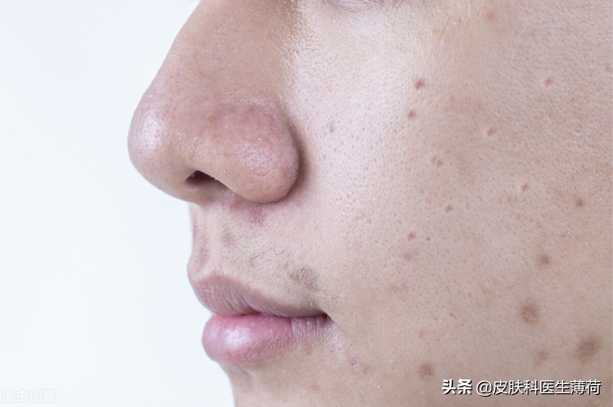 爆痘后如何有效预防痘印生成,长痘留下的痘印怎么去掉