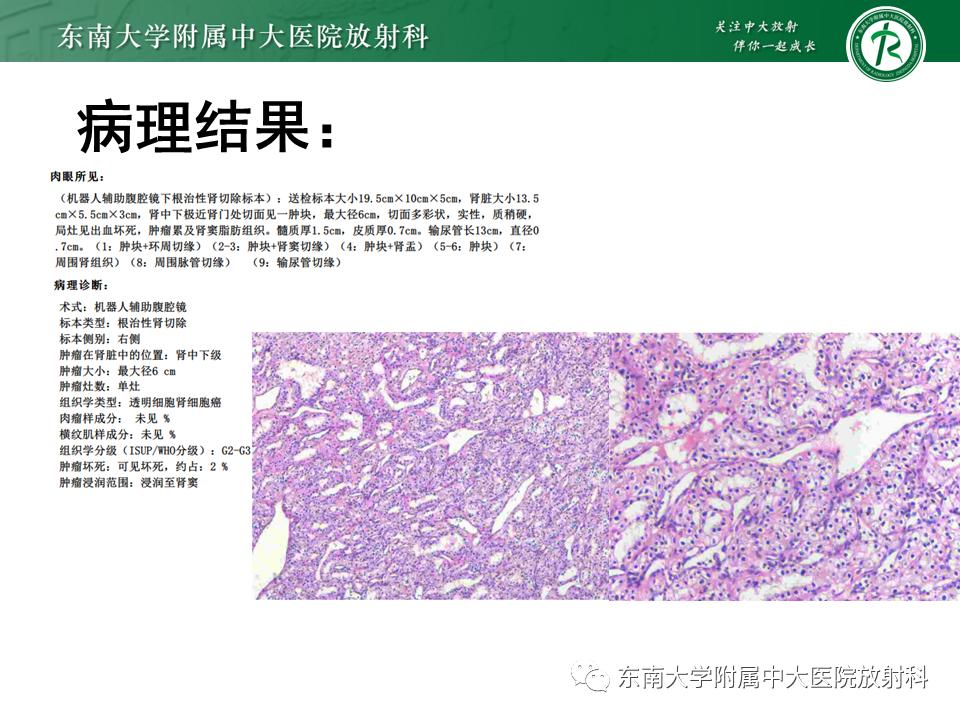 好文分享——《肾血管平滑肌脂肪瘤》