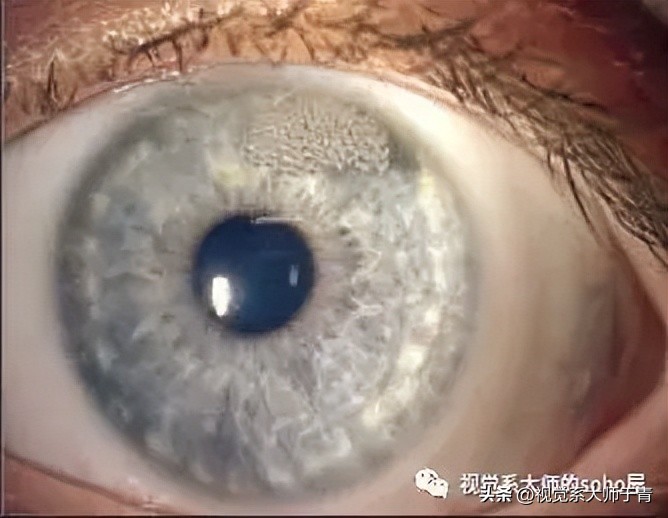 巩膜镜的验配技巧及案例分享,试戴巩膜镜成功率高不高