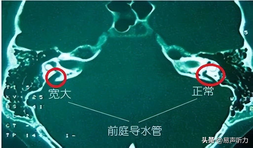 大前庭导水管综合征的护理ppt,什么是大前庭导水管综合征