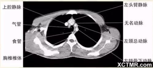 胸腹部盆腔ct主要检查什么,女性盆腔ct断层解剖结构图