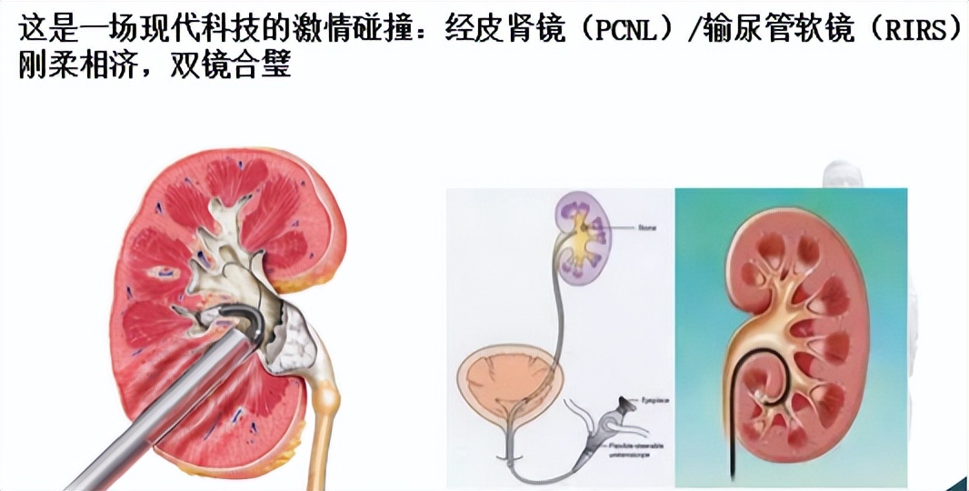明知山有虎,偏向虎山行——肾斗士VS肾结石