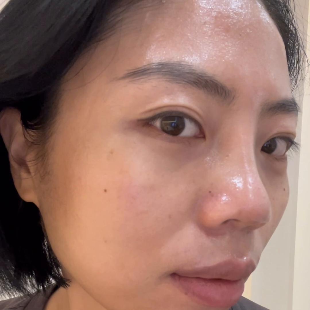 感觉目前很焦虑,做完鼻子19天为何山根看起来很宽