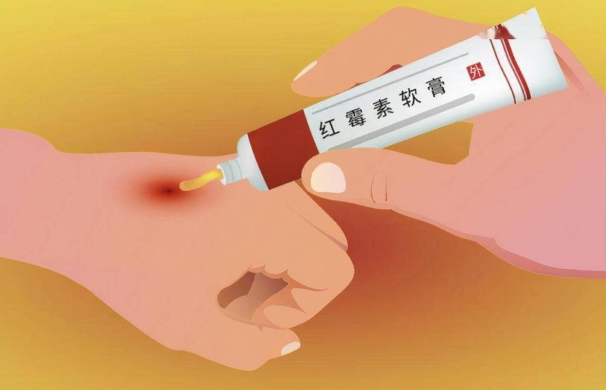 2块钱的红霉素软膏,红霉素软膏滥用