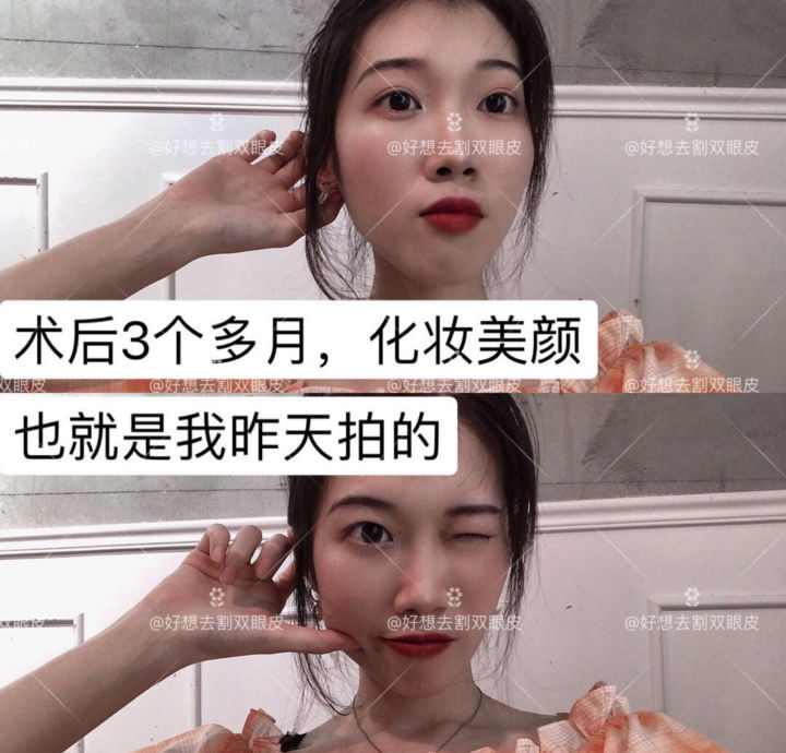 广州姑娘变美后亲述：“我的双眼皮切得很小，只有1厘米多一点”