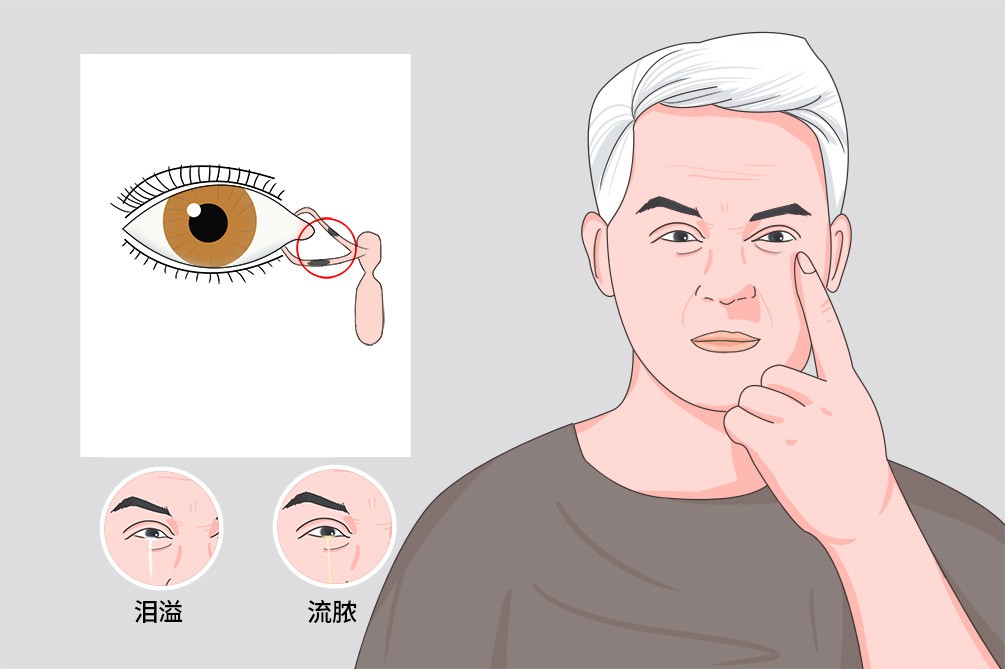泪囊吻合手术和置管有啥区别,泪囊切除术是几类切口