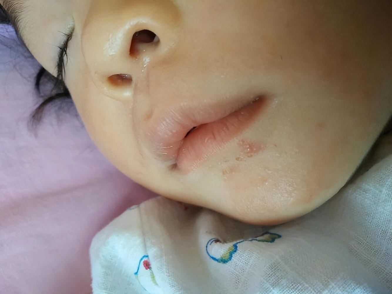 嘴角起小水泡是不是上火了,5岁的女儿3岁的儿子嘴角长水泡