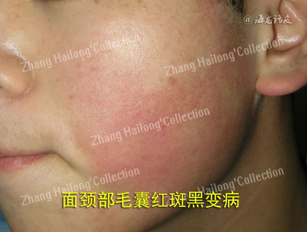 如何拯救鸡皮肤,如何拯救油腻鸡皮肤