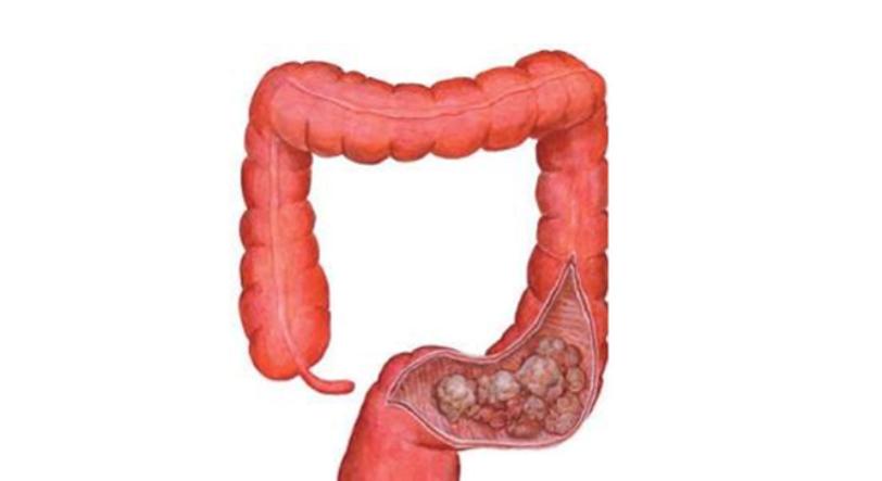 肠道多发息肉还是单发息肉严重,肠道扁平息肉厉害还是息肉厉害