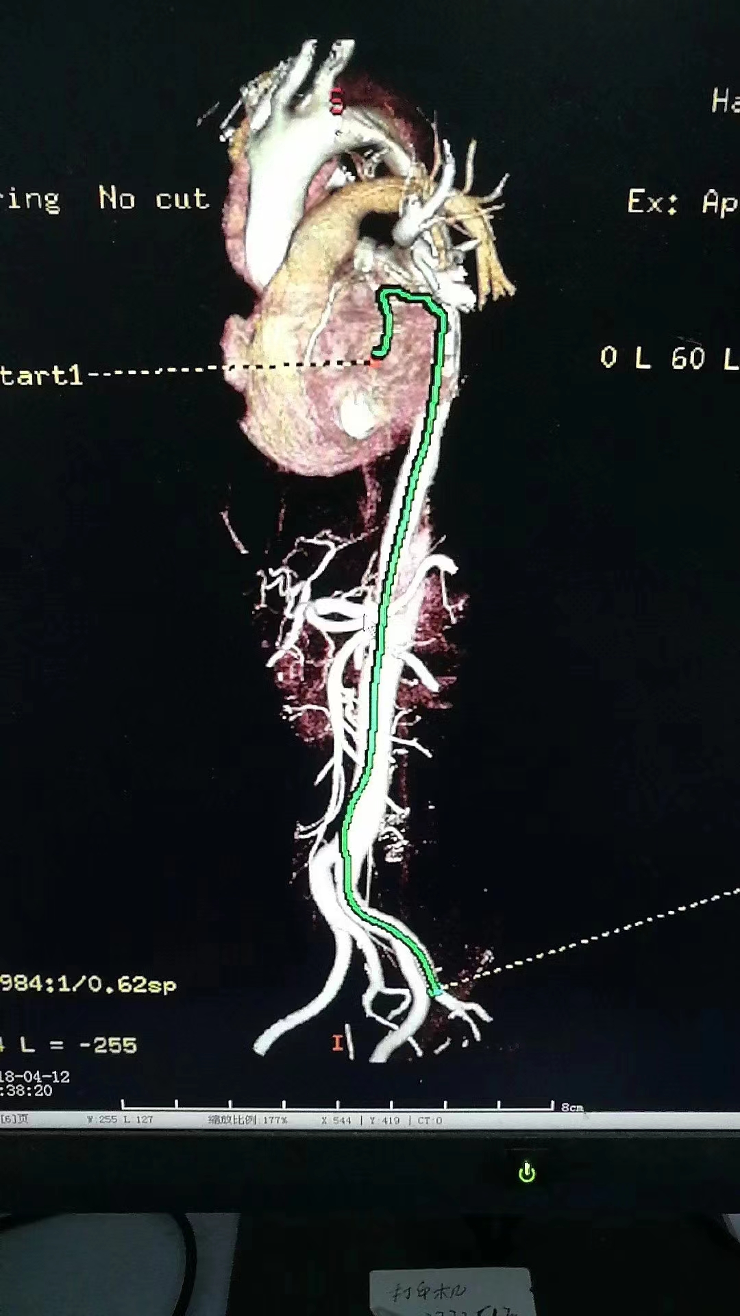 主动脉夹层心率太快,主动脉夹层的凶险