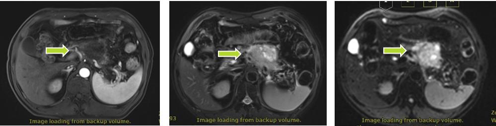 因为有你“胰”生平安——重（碳）离子治疗胰腺癌五问