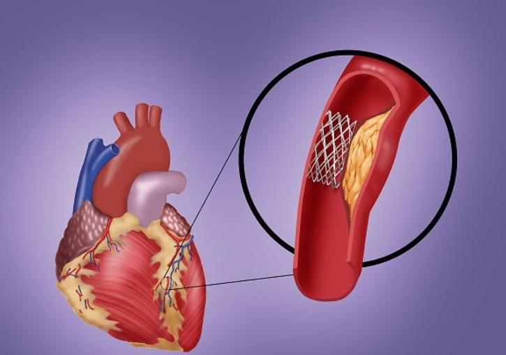 心脏支架手术一般能活多少年,做了心脏支架正常情况能活多少年