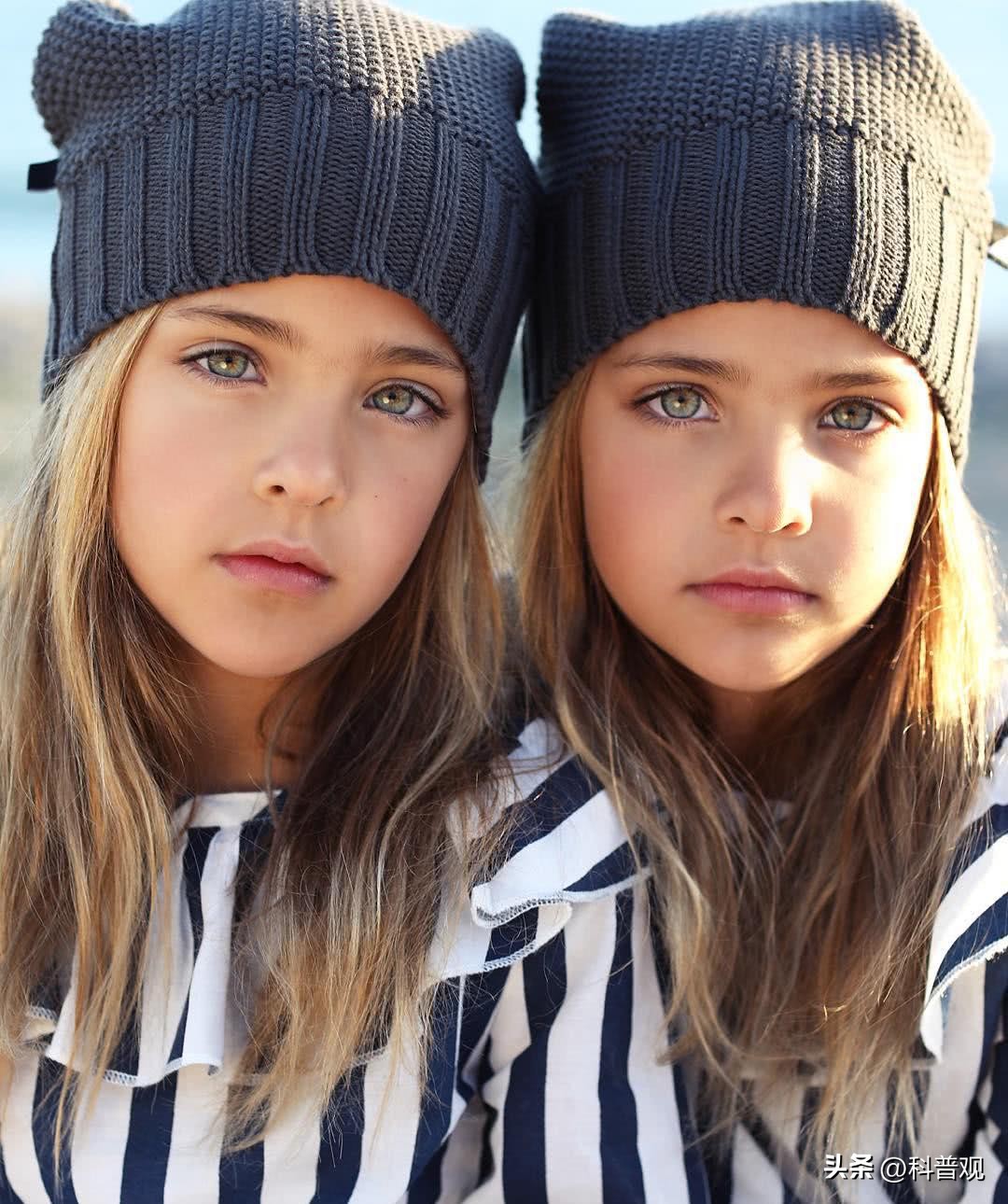 连体人一人去世了另一人会死吗,连体人死亡对另一半有影响吗