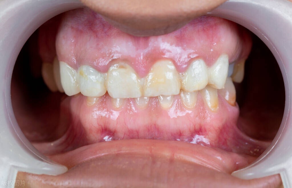 急性牙髓炎x线表现,狗牙髓炎的症状表现