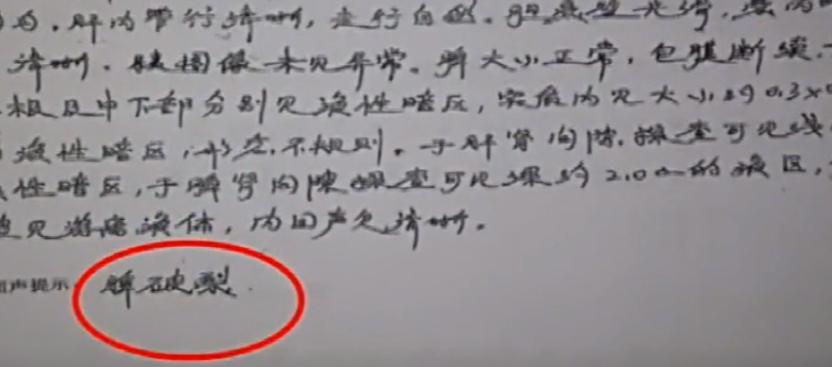 姑娘参加体检发现左肾丢失,左肾丢失的女孩最终结果