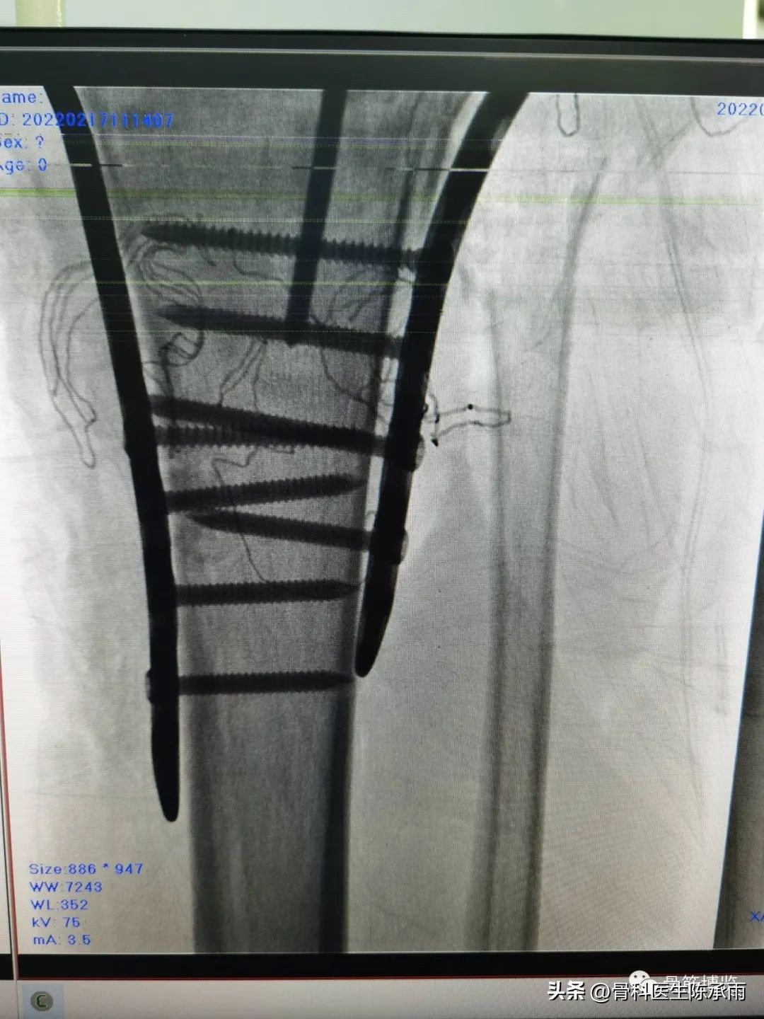 膝关节胫骨平台骨折,最近胫骨平台骨折视频
