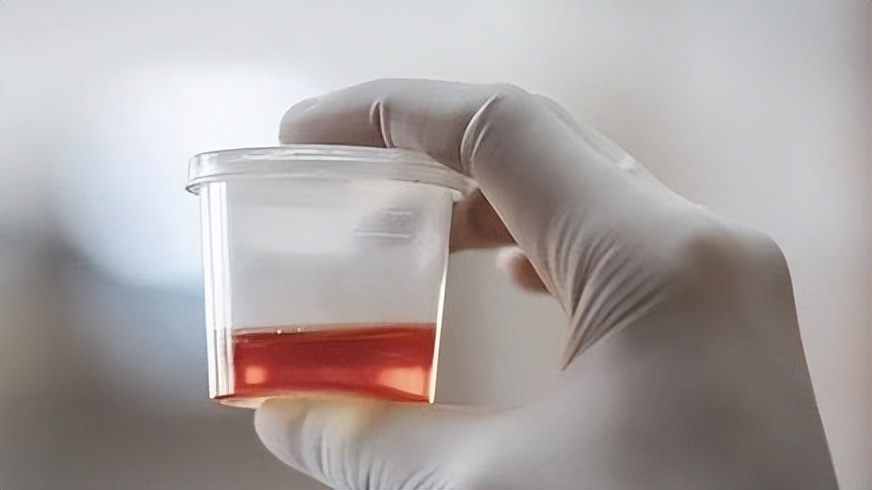 尿路感染就医要花1万多正常吗,尿路感染有5种征兆