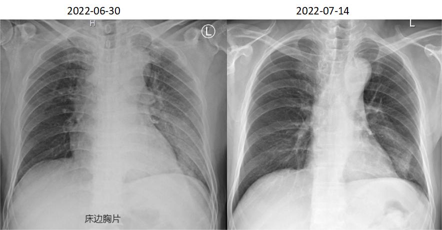 脓毒症住院五天接着发烧,脓毒症体温下降