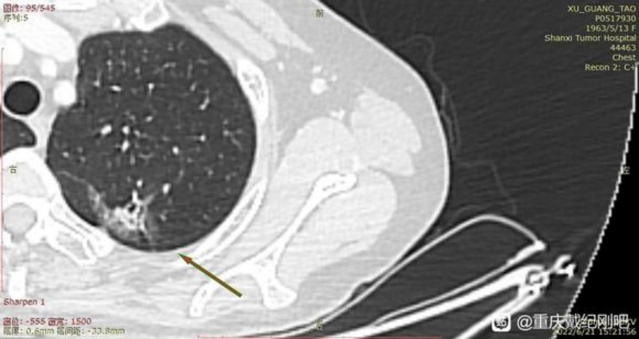 母亲腺癌,母亲确诊小细胞肺癌