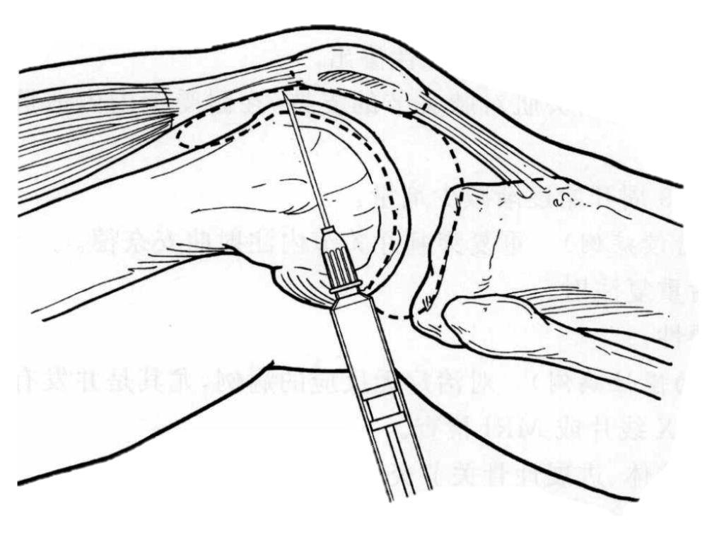 膝关节炎打玻璃酸钠几针见效,膝关节炎打玻璃酸钠好还是去针灸