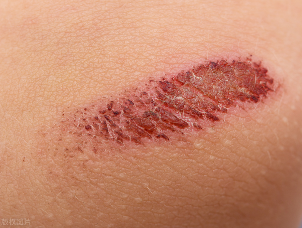别把艾滋病当皮肤病,艾滋病前期会有皮肤病么