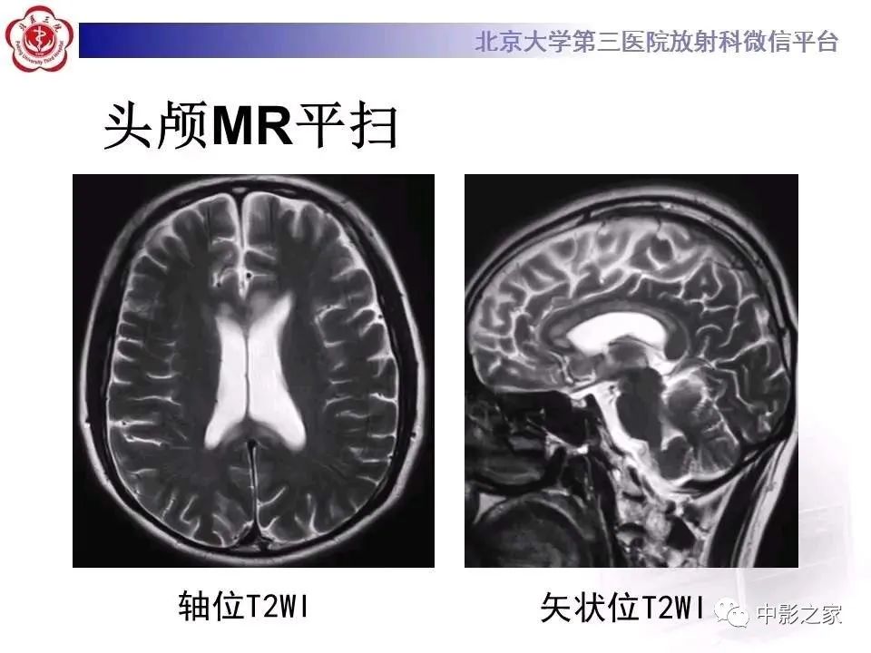 什么叫原发性胼胝体变性,原发性胼胝体变性治疗多少钱