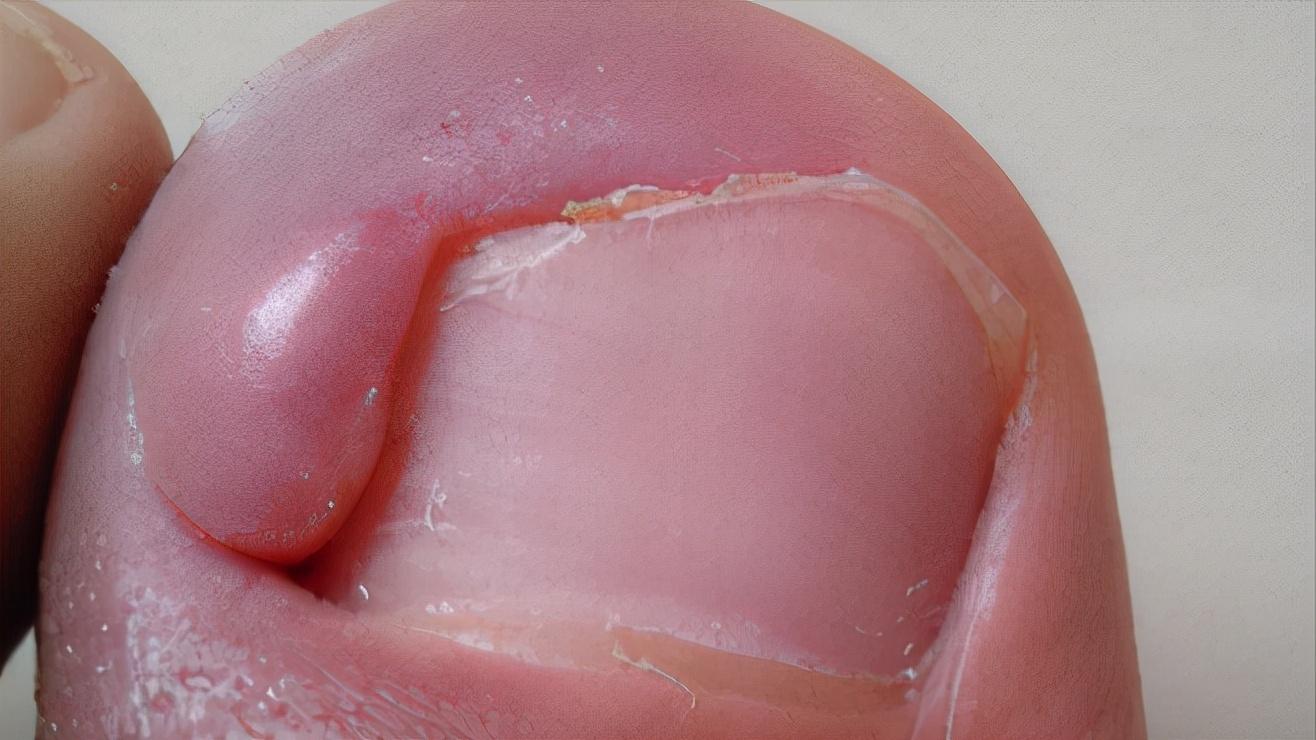 指甲往肉里长怎么办,指甲老往肉里钻