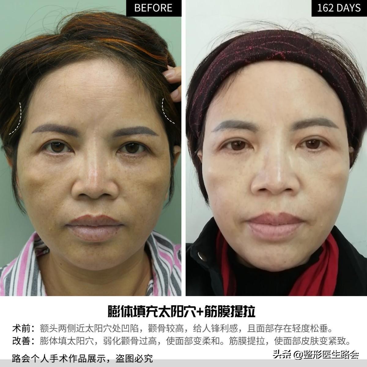 脸干有细纹显老,脸部皮肤黑显老怎么办