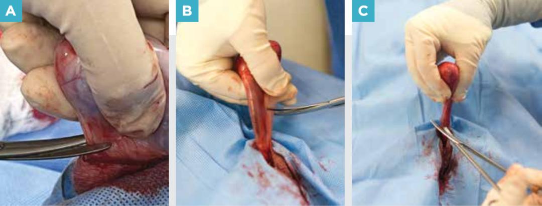 附睾炎切除术多少钱,附睾炎微创手术治疗全过程