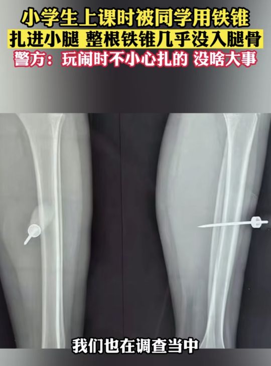 男孩被同学铁锥扎腿,小学生用铅笔扎伤同学可以报警吗