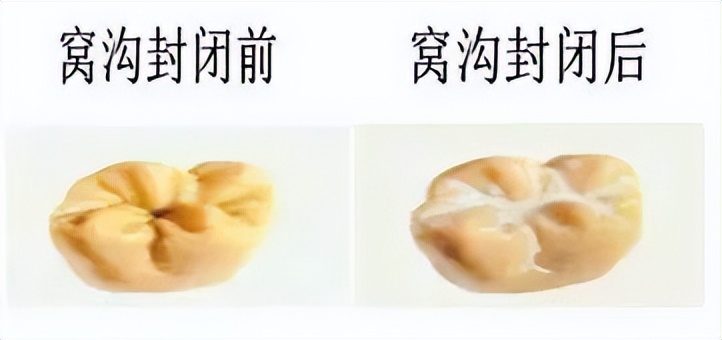 简述预防儿童龋齿的措施,婴儿怎么预防龋齿的有效方法