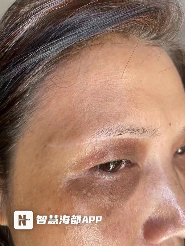 福州医美中介水太深，“闺蜜”介绍手术，发票价与实际花费差十倍