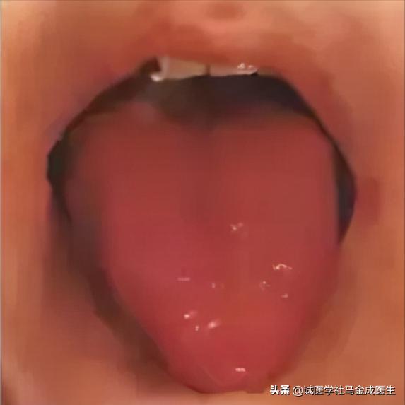 风热或痰热咳嗽阴虚干咳者不适用,阴虚火旺咳嗽痰黄吃什么中成药