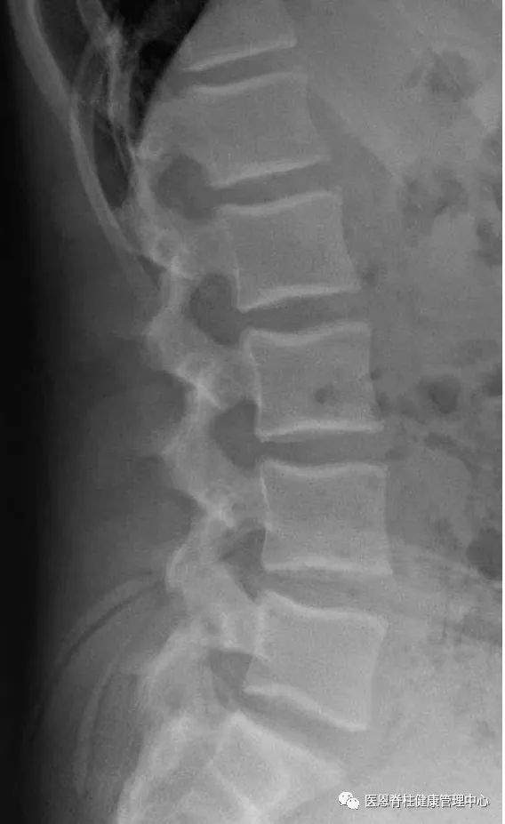 腰椎生理前凸消失是什么意思,颈椎间盘向后局限性突出