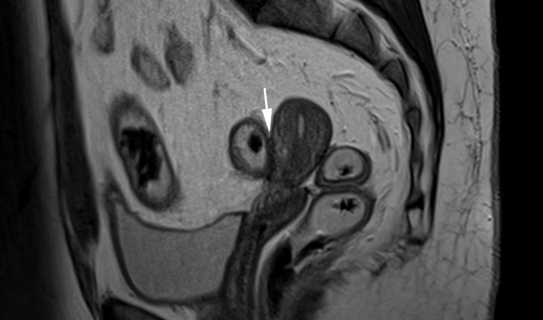 MRI如何评估子宫内膜异位症？这10个病例会帮助您