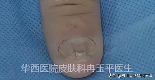 灰指甲到底算什么病,指甲黄是不是灰指甲