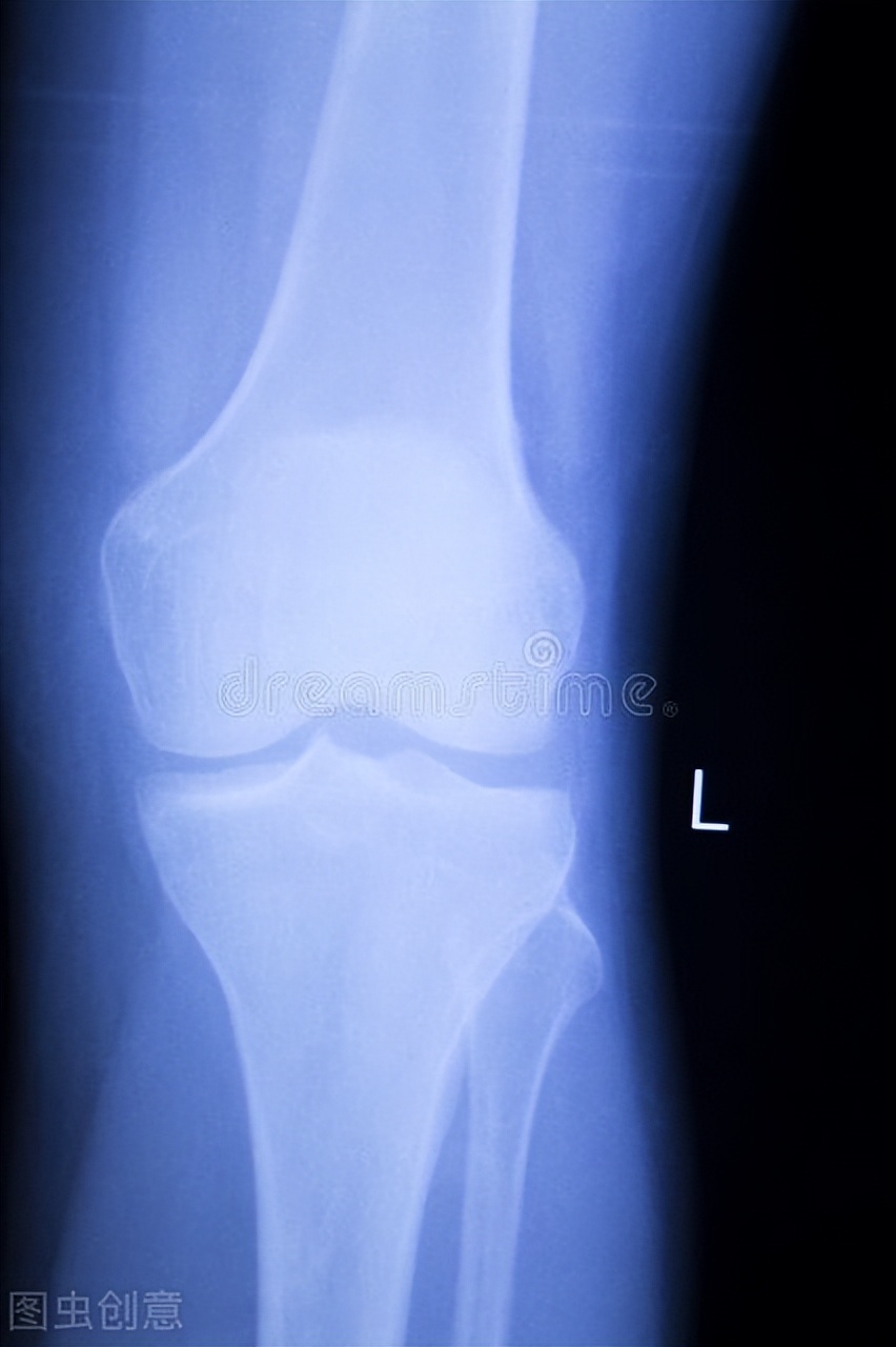 93斤女子跳绳4千下半月板撕裂,半月板撕裂能跳绳吗