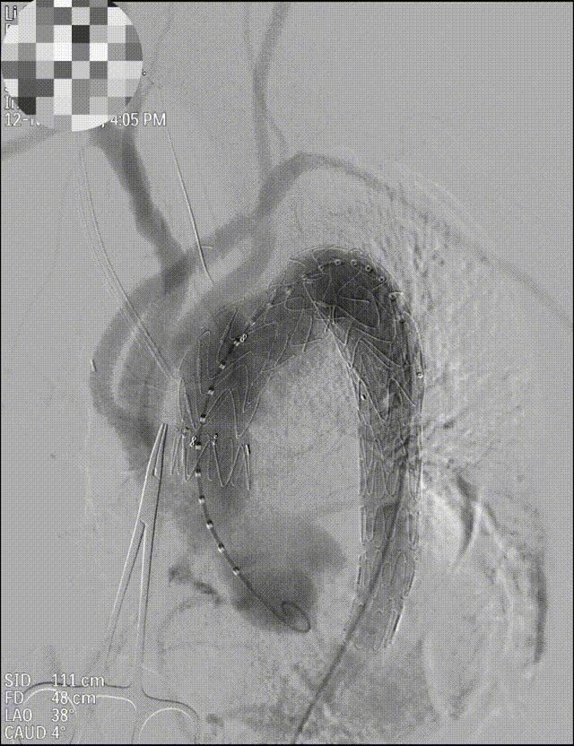 主动脉夹层动脉瘤哪个医院好,主动脉夹层动脉瘤遗传率多高